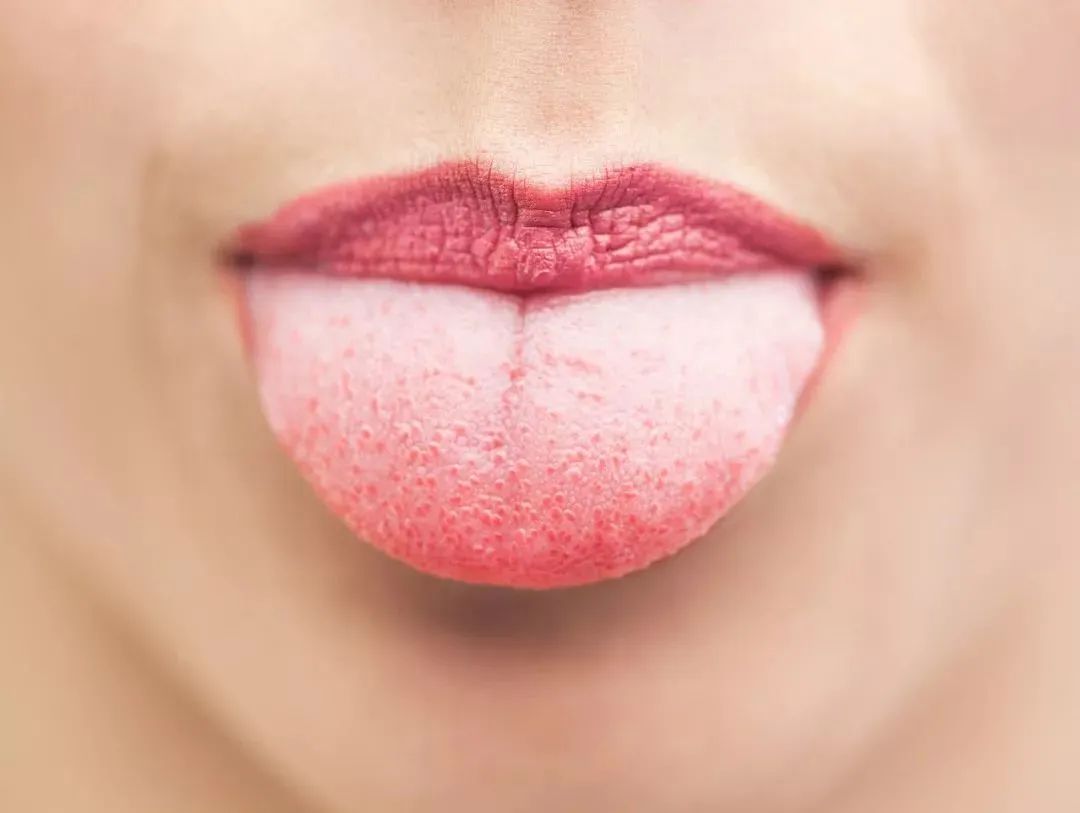 舌头是疾病的"照妖镜"，舌头出现这些症状要注意！